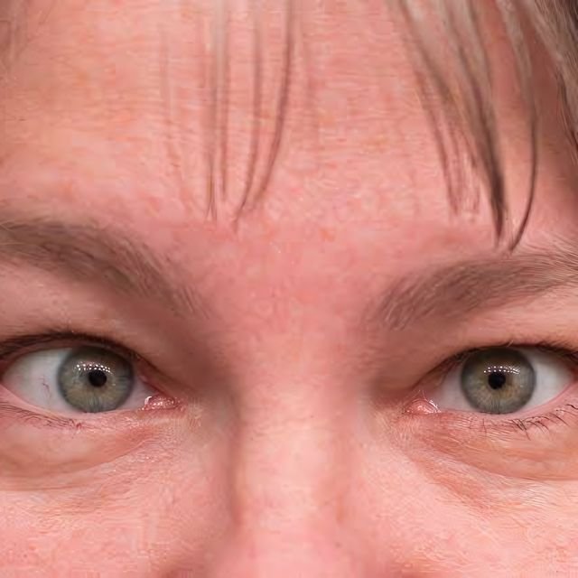 Close up of a woman's eyes: one looks straight ahead while the other drifts outward