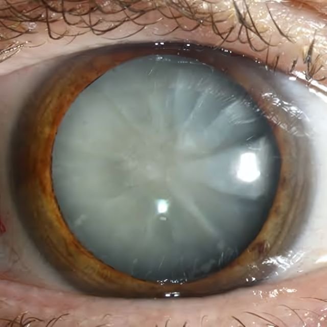 Close up of an eye with a cataract: the lens behind the pupil has turned cloudy grey