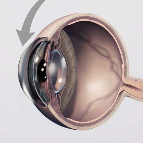Cut away drawing of the eye, with an arrow pointing to the cornea, the clear dome at the front