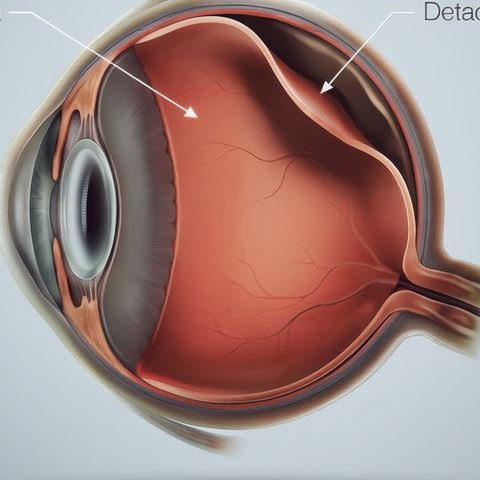 Cut away drawing of the eye, showing the retina peeling away from the back wall